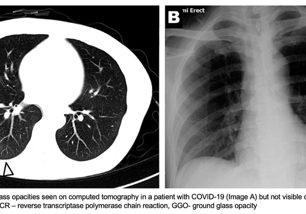 Medium Blog: Journey through COVID-19 RSNA Papers