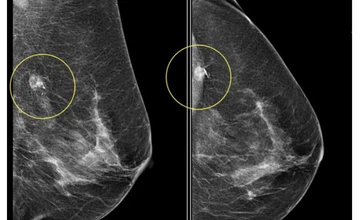 Breast Mammography Dataset (Lebanon & international cohorts)