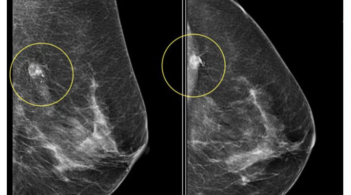 Breast Mammography Dataset (Lebanon & international cohorts)
