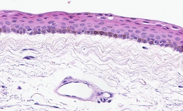 Conjunctival Melanocytic Intraepithelial Lesion (CMIL) Histopathology Dataset