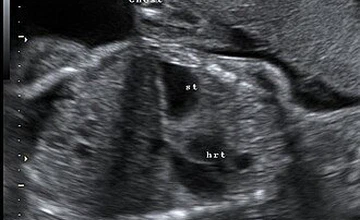 Fetal Ultrasound Dataset for Congenital Diaphragmatic Hernia