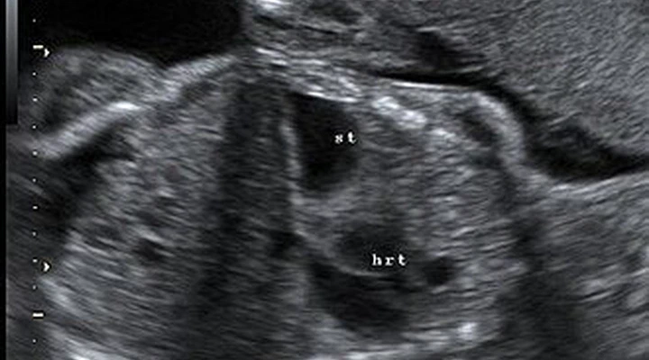 Fetal Ultrasound Dataset for Congenital Diaphragmatic Hernia
