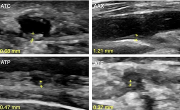 Giant Cell Arteritis Ultrasound Dataset