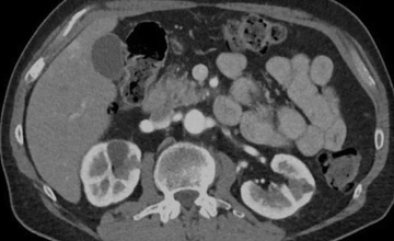 Pancreatic Ductal Adenocarcinoma Multi-Center CT Dataset