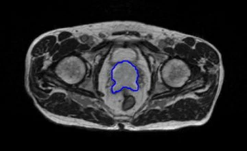 Prostate MRI Dataset with MR Fingerprinting