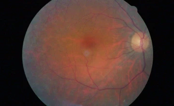 Retinal Fundus Image Dataset