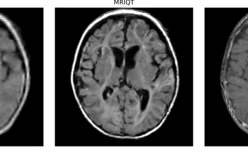 MRIQT — Image-Quality Transfer for Ultra-Low-Field MRI