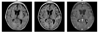Ultra-low-field input, MRIQT output and high-field reference for one case