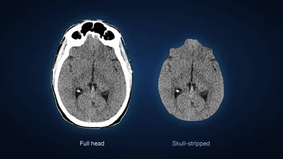 Unsupervised anomaly detection in full-head CT for emergency triage featured image