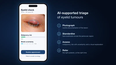 KI-gestützte Diagnostik von Tumoren am Auge: Dignitätseinordnung von Lidtumoren mittels KI zur optimierten Patienteneinbestellung featured image