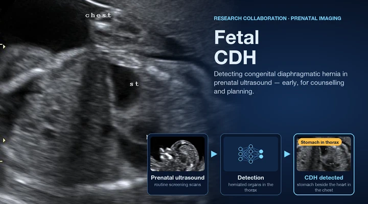 Deep learning for fetal diaphragmatic hernia detection in ultrasound