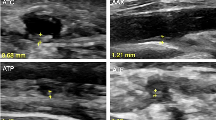 GCA-US-AI: Deep learning–based ultrasound diagnosis of Giant Cell Arteritis