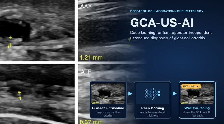 GCA-US-AI: Deep learning–based ultrasound diagnosis of Giant Cell Arteritis