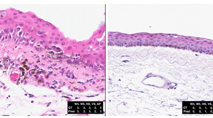 INTERACT-CMIL: Interpretable multi-task grading of conjunctival melanocytic lesions
