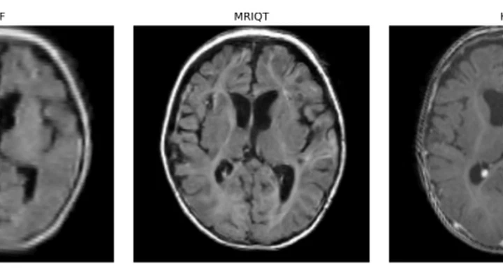 MRIQT: Image-quality transfer from ultra-low-field to high-field neonatal MRI