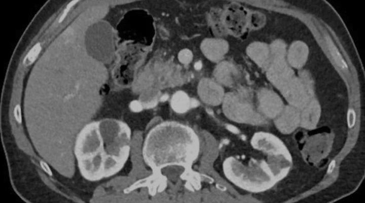 Federated foundation models for multi-center CT staging of pancreatic cancer