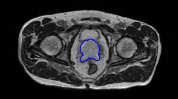 Deep learning for clinically significant prostate cancer in 3D mpMRI and MR Fingerprinting
