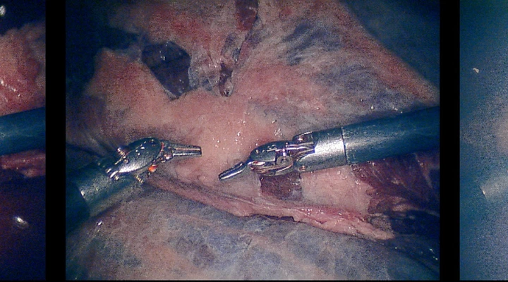 Robust surgical tool segmentation with state-space vision models