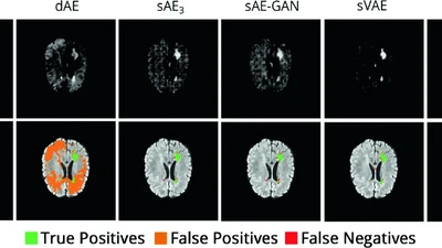 Deep autoencoding models for unsupervised anomaly segmentation in brain MR images featured image