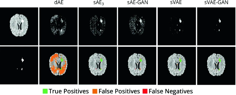 Deep autoencoding models for unsupervised anomaly segmentation in brain MR images