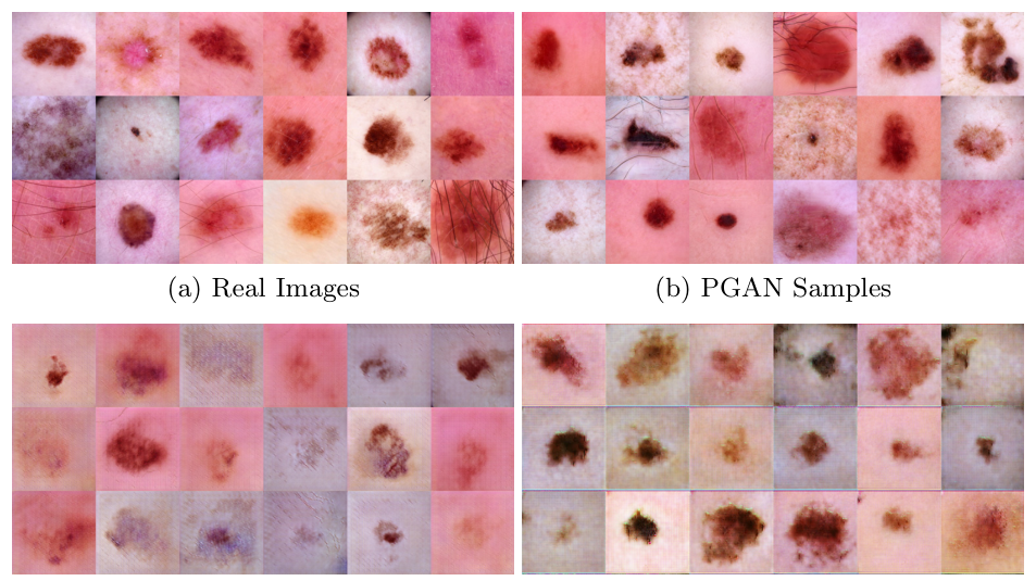Generating highly realistic images of skin lesions with GANs ...