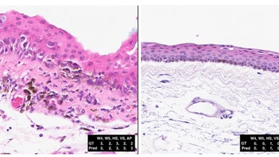 INTERACT-CMIL: Multi-Task Shared Learning and Inter-Task Consistency for Conjunctival Melanocytic Intraepithelial Lesion Grading featured image
