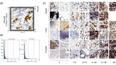 LYSTO: The lymphocyte assessment hackathon and benchmark dataset featured image