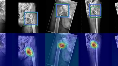 Towards an Interactive and Interpretable CAD System to Support Proximal Femur Fracture Classification featured image