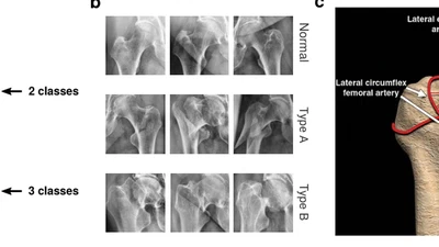 Precise proximal femur fracture classification for interactive training and surgical planning. featured image
