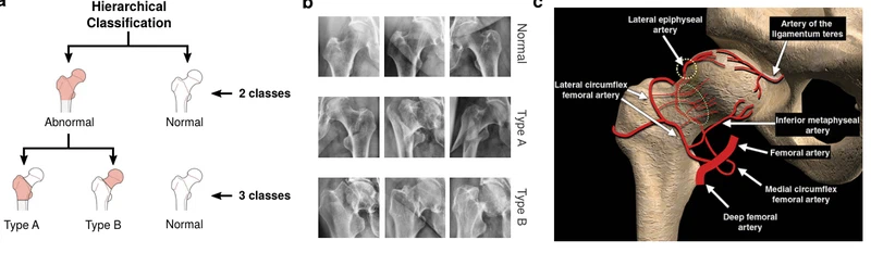 Precise proximal femur fracture classification for interactive training and surgical planning.
