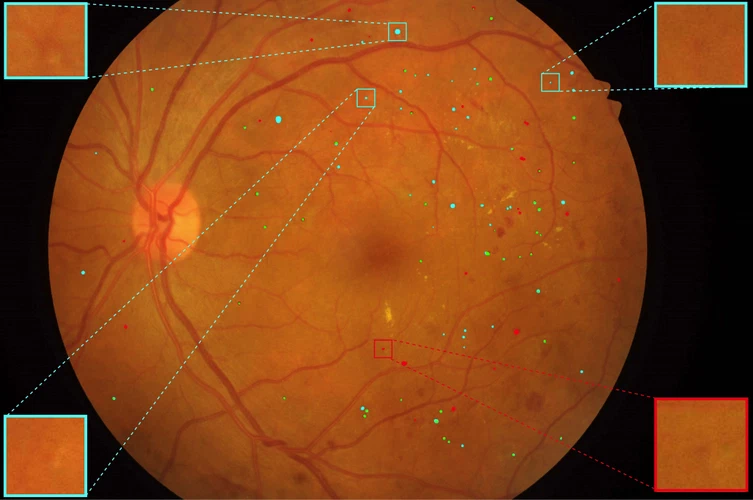 Multi-scale Microaneurysms Segmentation Using Embedding Triplet Loss