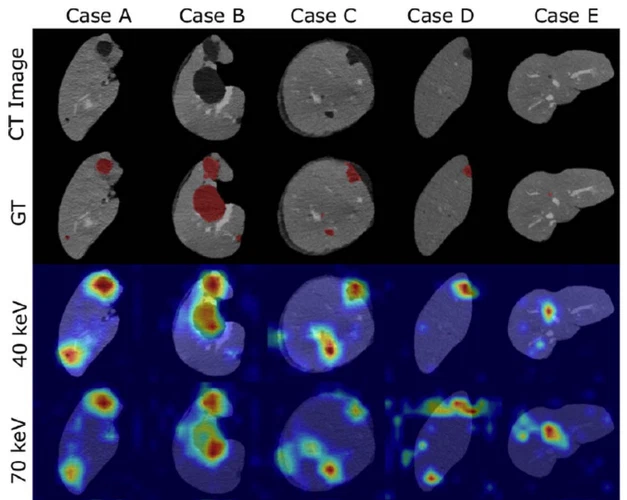 Benefit of dual energy CT for lesion localization and classification with convolutional neural networks