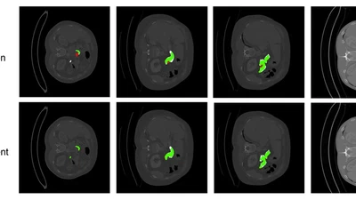 Uncertainty-based graph convolutional networks for organ segmentation refinement featured image