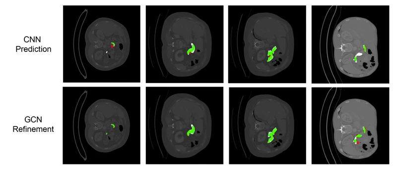 Uncertainty-based graph convolutional networks for organ segmentation refinement
