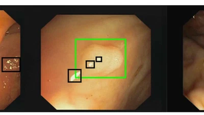 Polyp-artifact relationship analysis using graph inductive learned representations featured image